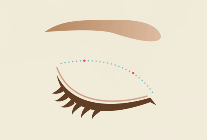 ナチュラルクイック法